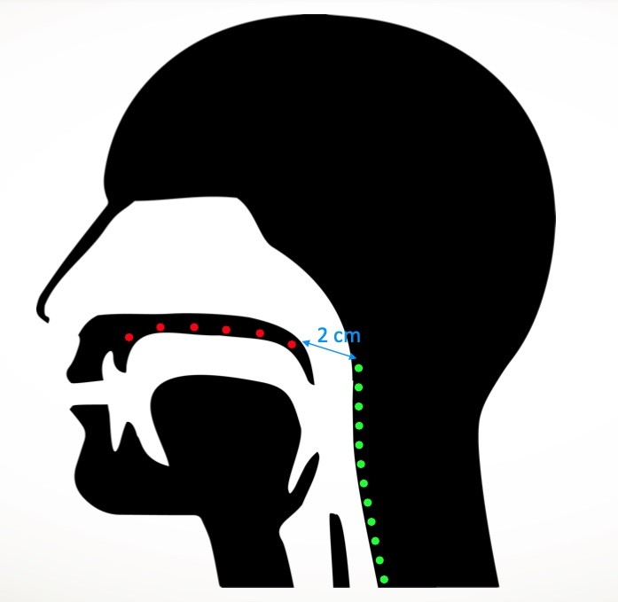 Non-intrusive sleep apnea diagnosis preview article image